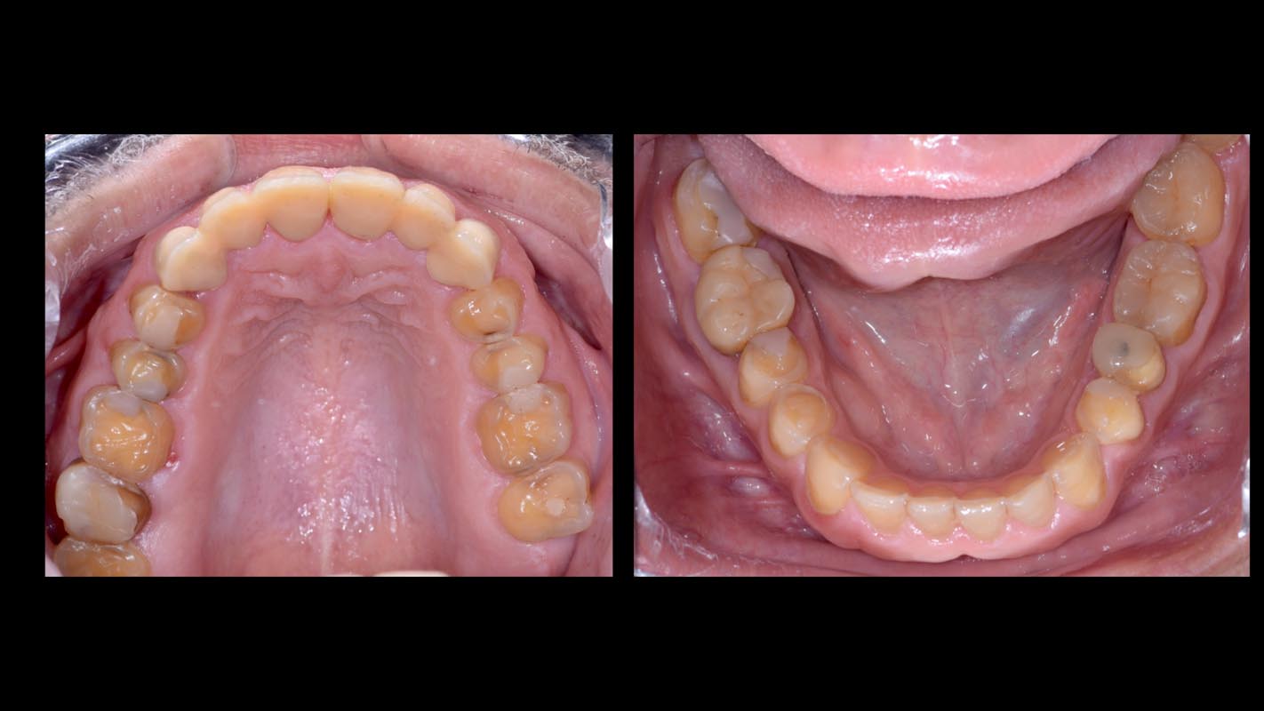 Bocca dall'alto con denti consumati