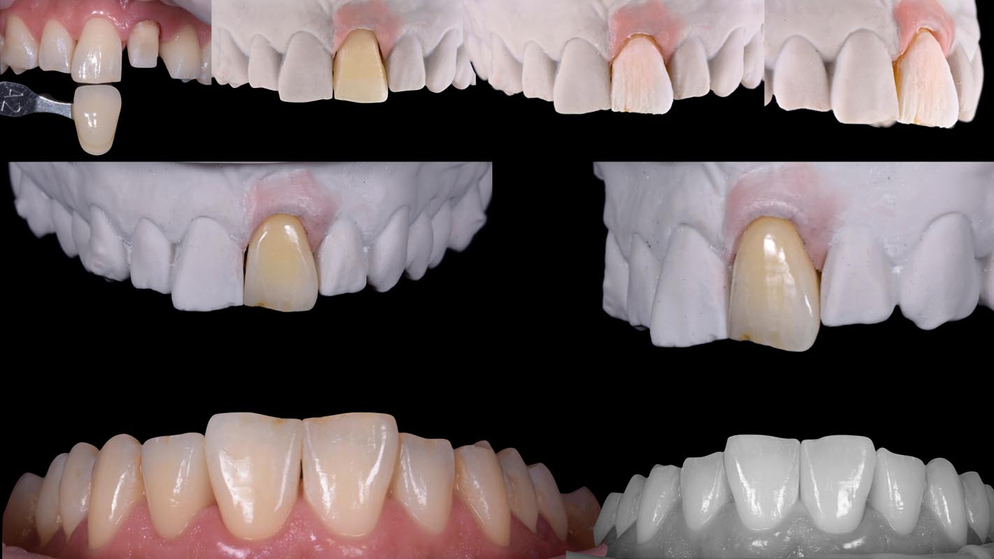 il dente singolo.003
