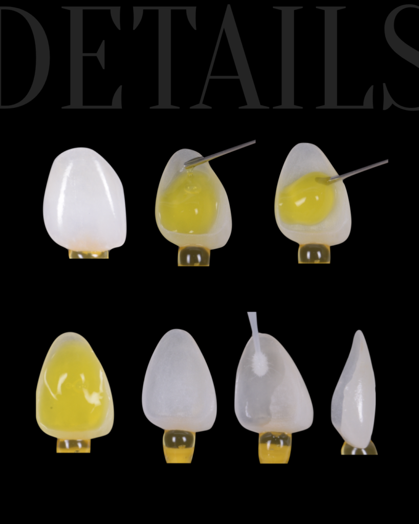 Faccette dentali naturali Bitonto Dott. Paolo Scattarelli