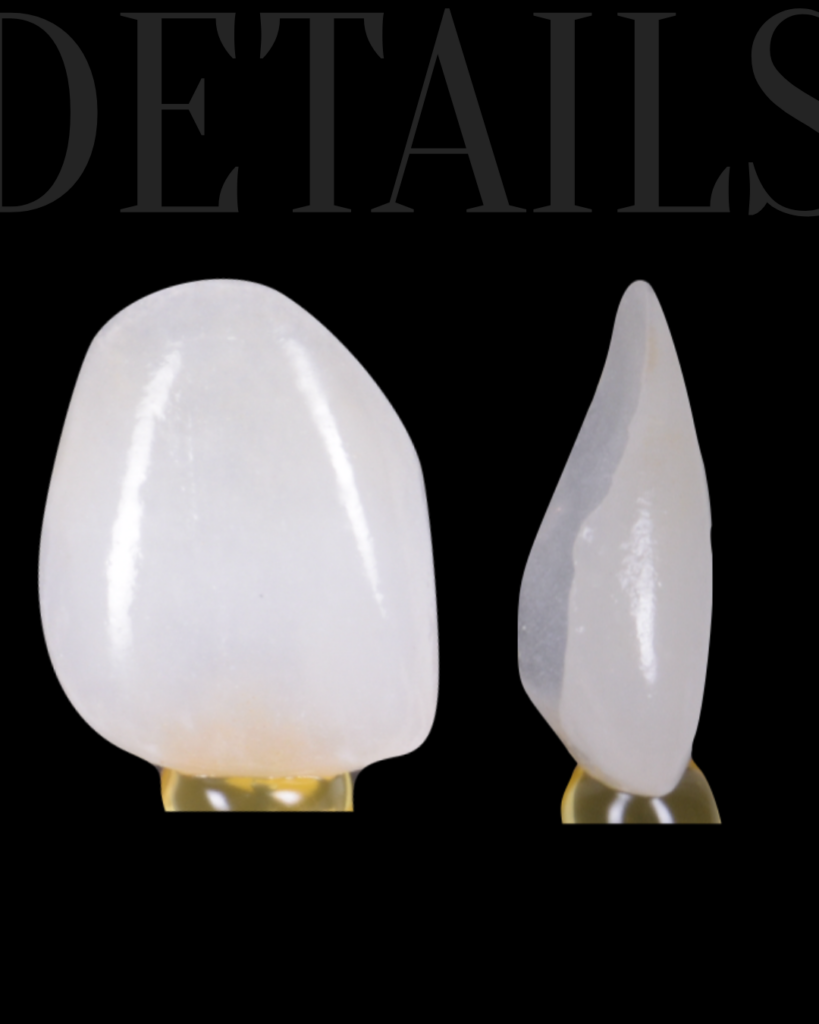 Faccette dentali naturali Bitonto Dott. Paolo Scattarelli