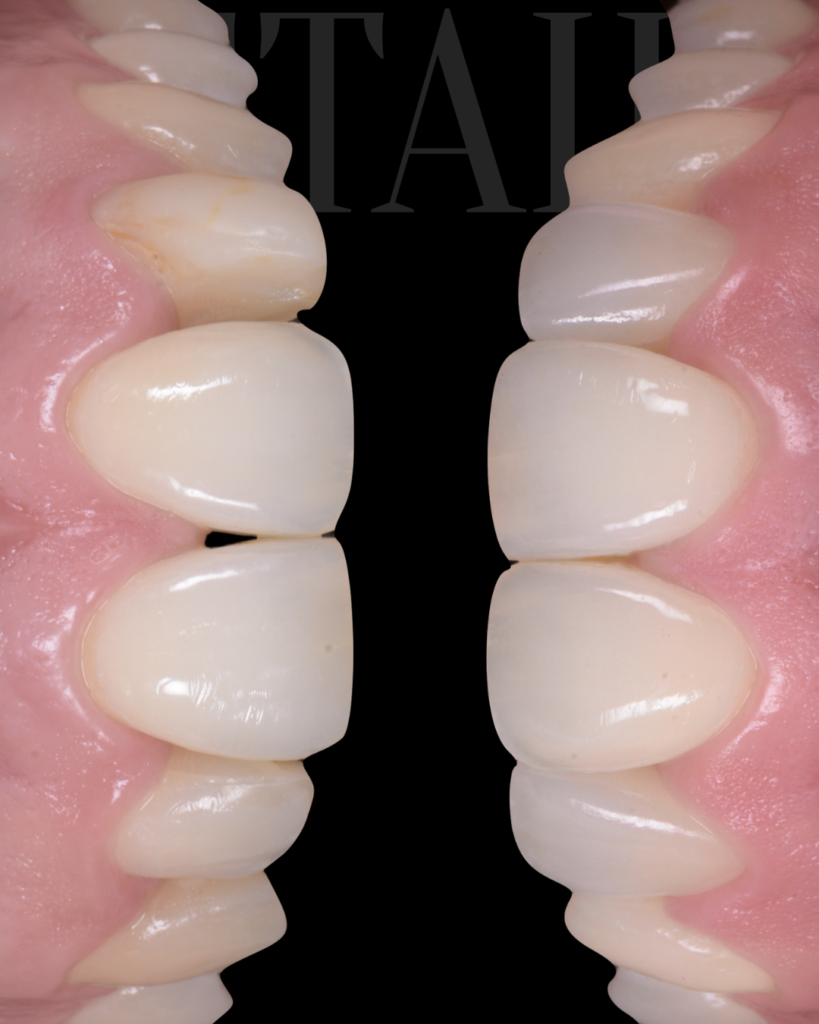 Faccette dentali naturali Bitonto Dott. Paolo Scattarelli